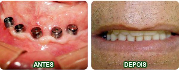 caso-01-implante1-protocolo-inferior-1